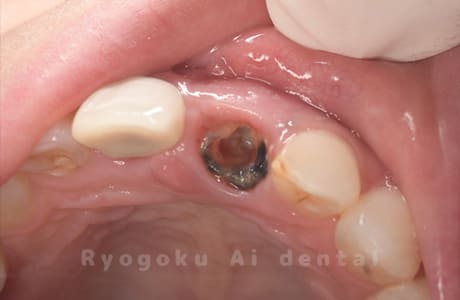 前歯部重度カリエス