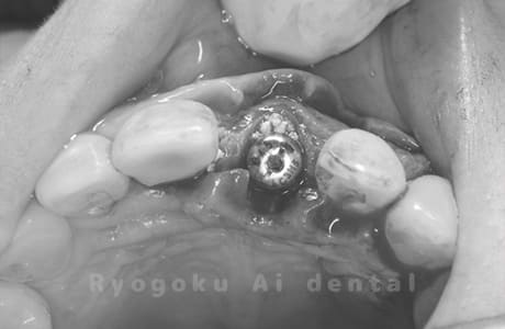 インプラント埋入後骨造成