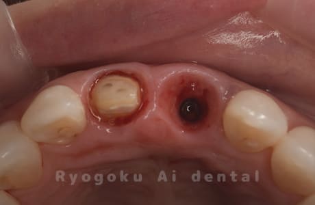 インプラント術後