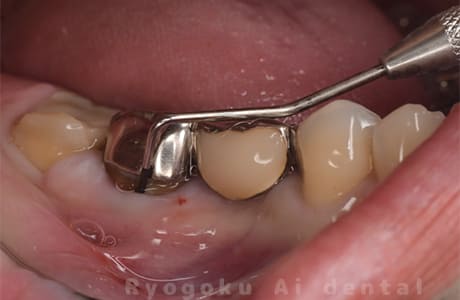 前歯部重度カリエス