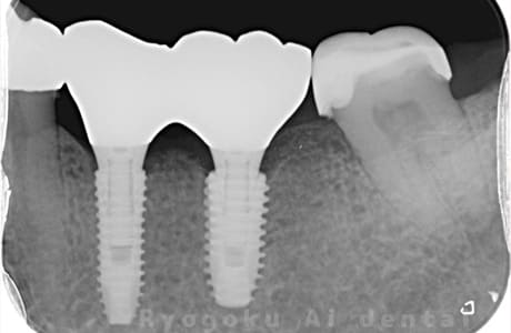 インプラント埋入後骨造成