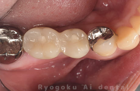 インプラント術後