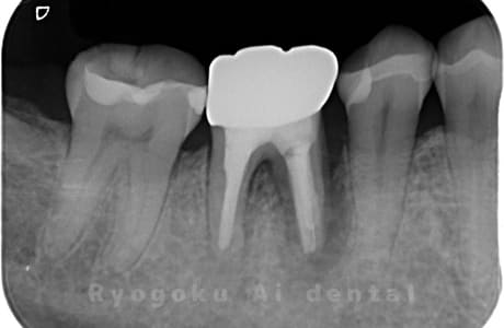 右下６番歯根破折