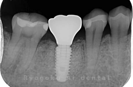 インプラント治療後のレントゲン
