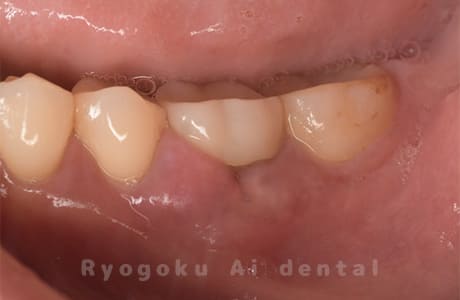 右下６番歯根破折