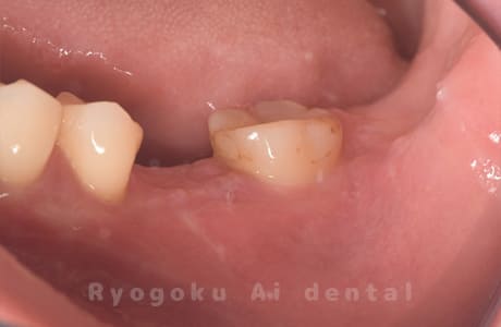 抜歯後側面
