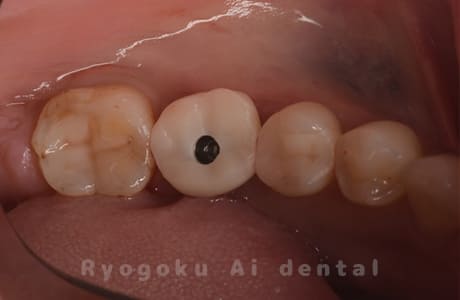 インプラント治療１