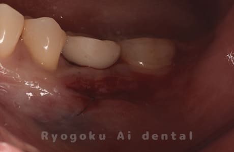 インプラント治療２