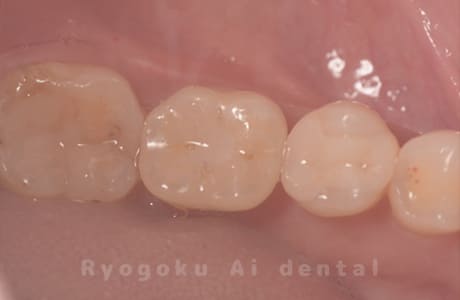 インプラント治療３