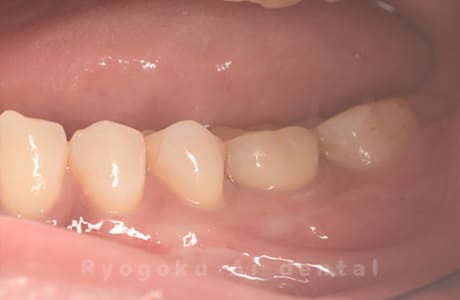 インプラント術後