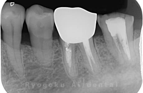 左下７番歯根破折