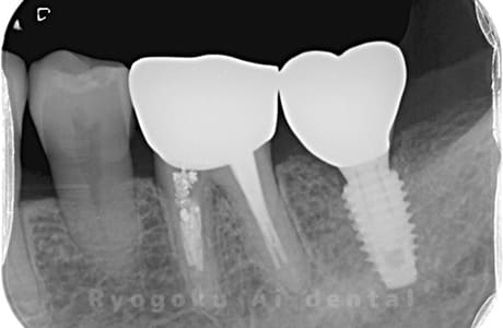 インプラント治療後のレントゲン