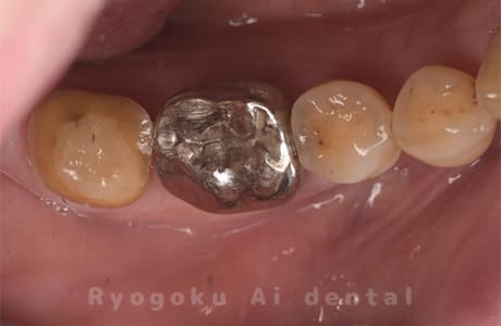 右下６番歯根破折