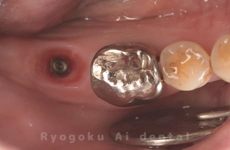 インプラント埋入後