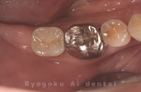 インプラント術後