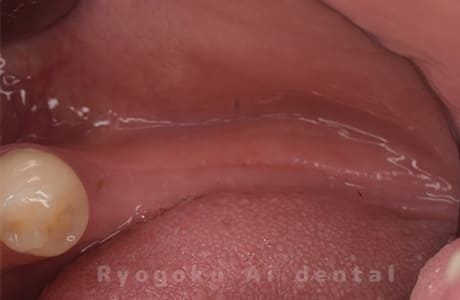 左下５、６、７欠損