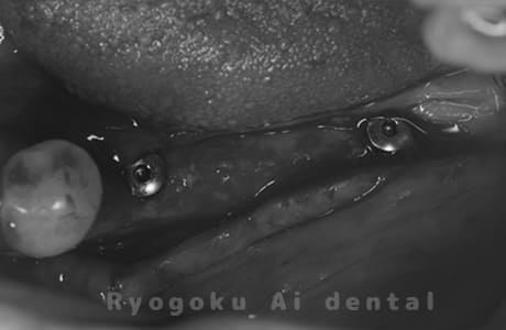 インプラント埋入