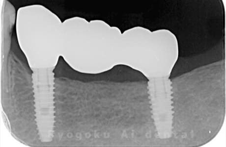 インプラント治療後レントゲン写真