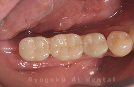 インプラント治療術後