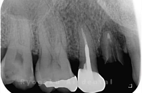 右上４番歯牙破折レントゲン