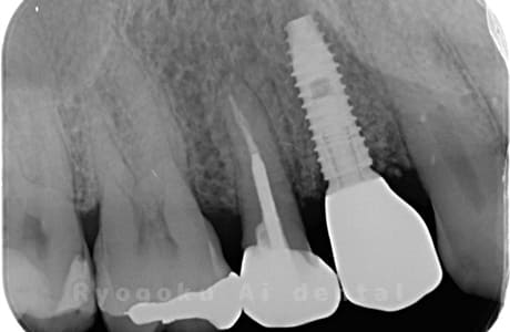 インプラント術後レントゲン