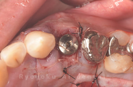 インプラント埋入