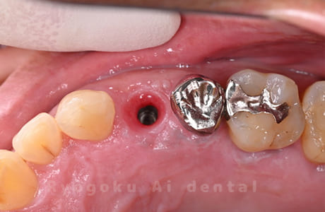 インプラント治療後