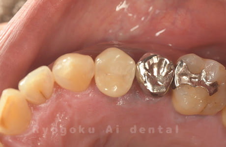 インプラント治療術後