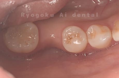 右上４番歯牙破折