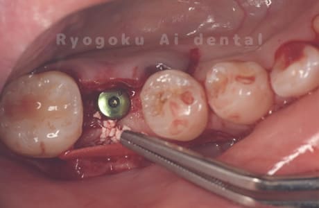 インプラント埋入