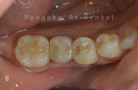 インプラント治療術後