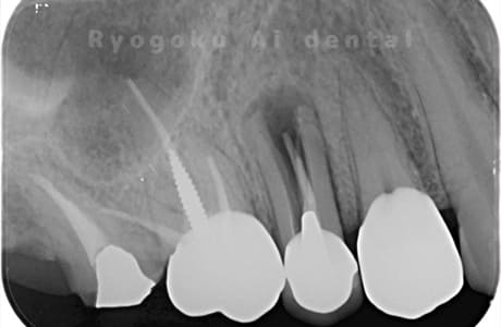 右上５番歯根破折レントゲン