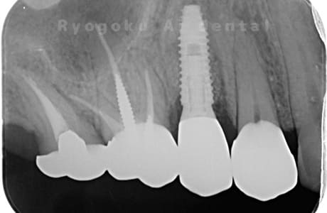 インプラント術後レントゲン