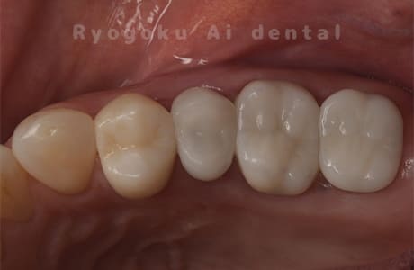 右上５番歯根破折