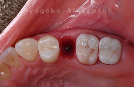 インプラント埋入