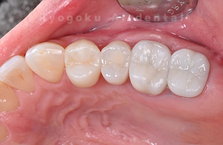 インプラント治療後
