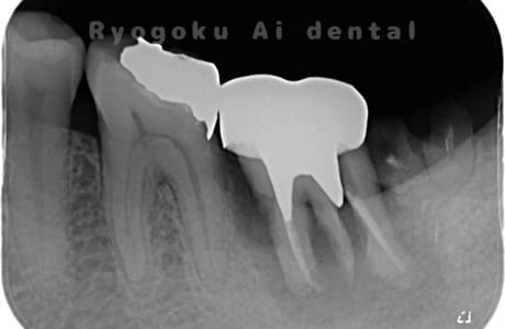 左下７番歯牙破レントゲン