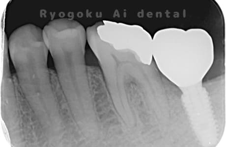 インプラント術後レントゲン