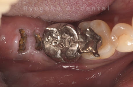 左下７番歯牙破折