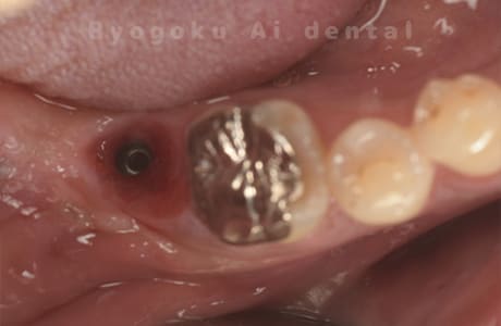 インプラント埋入後