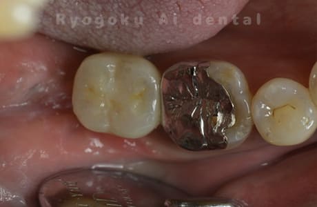 インプラント治療術後