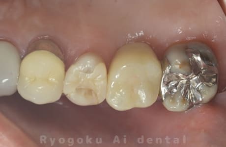 インプラント治療