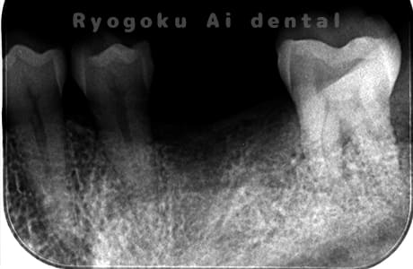 歯の欠損レントゲン
