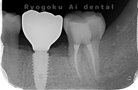 インプラント治療後術後レントゲン
