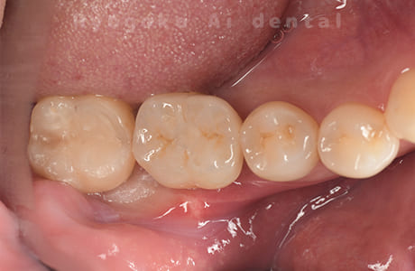 インプラント治療術後