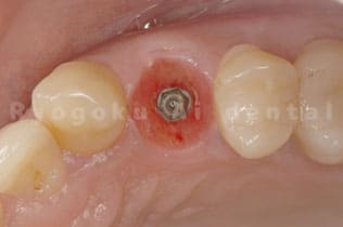 インプラントが問題なく骨と付いているのを確認できたら型取り