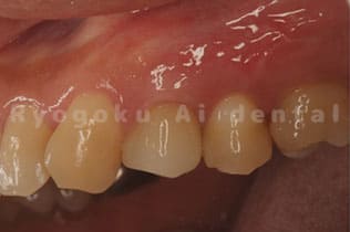 インプラント治療終了