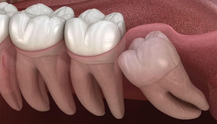 痛みが少ない親知らずの抜歯
