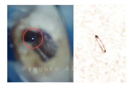 マイクロスコープで根管内の異物を確認
