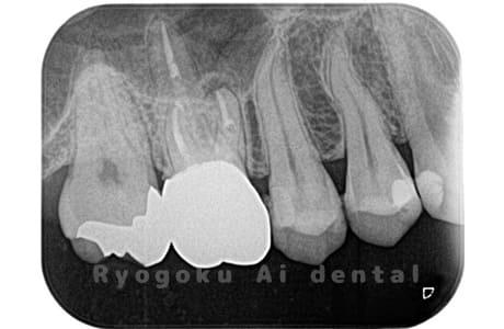 マイクロスコープを使用した根管内異物除去並びにマイクロエンド